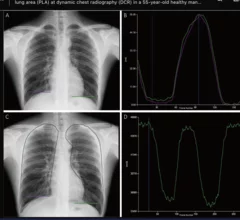 Dynamic chest radiography could be an alternative to pulmonary function tests for diagnosing COPD