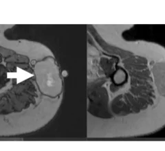 ST-RADS scoring system for predicting risk of soft tissue tumor malignancy