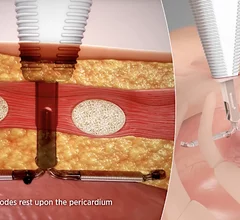 Abbott recently announced it is partnering with AtaCor Medical to develop a next-generation extravascular implantable cardioverter defibrillator (EV-ICD) system. AtaCor's investigational extravascular ICD lead will be paired with Abbott's investigational extravascular ICD system. 