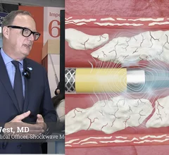 Nick West, MD, chief medical officer, Shockwave Medical, Johnson and Johnson Meditech, explains how the company is innovating intravascular lithotripsy (IVL) therapy devices and building clinical evidence from trials for its use in a variety of calcified lesions. There are several companies developing IVL therapy, but West says Shockwave will remain the market leader because of its nearly decade long head start in the market, strong clinical evidence and has about a 10% market penetration. #IVKL