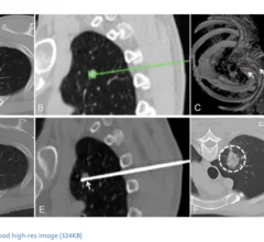 Robotic-assisted RFAs yield better outcomes during lung tumor ablations