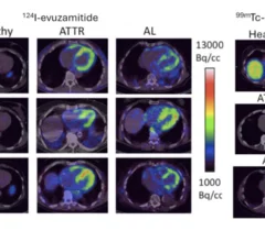 PET-CT imaging of 124-I evuzamitide and SPECT-CT imaging of 99mTc-p5+14 showed radiotracer uptake in both AL and ATTR amyloid throughout the myocardium. Emily B. Martin, Anne Kassira, Alan Stuckey, et al. A tale of two tracers - Amyloid imaging with investigational radiotracers iodine (124I) evuzamitide and 99mTc-p5+14 (AT-05). https://www.journalofnuclearcardiology.org/article/S1071-3581(25)00325-3/abstract.