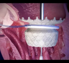 HighLife Transcatheter Mitral Valve Replacement (TMVR) System