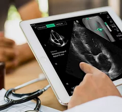 The U.S. Food and Drug Administration (FDA) has granted UltraSight an expansion of its Echo Stewardship Platform compatibility with additional ultrasound system types. This enables deployment of artificial intelligence (AI) guidance for focused cardiac ultrasound (FoCUS) across an entire healthcare system without the need to buy new ultrasound systems. The move enables health systems to expand use of the AI on compatible equipment they already own, including handheld, laptop and cart-based systems.