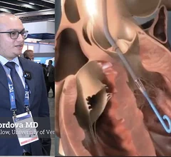 Andres Cordova, MD, cardiology fellow, University of Vermont Medical Center, explains a study of registry and outcomes data on the use of Impella hemodynamic support in elderly STEMI patients with cardiogenic shock.