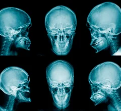 facial x-ray radiograph
