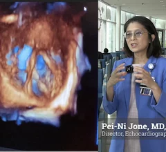 Pei-Ni Jone explains ASE push for 3D TEE in congenital heart