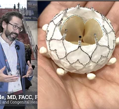 Transcatheter treatment of tricuspid valve disease has rapidly evolved over the past two years, giving physicians new tools to address a condition long considered under treated due to limited procedural options and complex anatomy. Ryan K. Kaple, MD, FACC, FSCAI, director of the structural and congenital heart program at Hackensack University Medical Center, spoke top Cardiovascular Business about recent advances and his center's real-world experience.