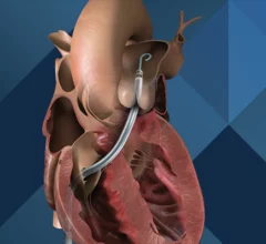 The Impella RP with SmartAssist. Image courtesy of Johnson & Johnson MedTech.