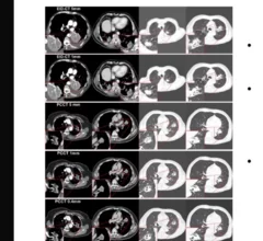 Photon-counting CT scans best conventional CTs for lung cancer follow-up