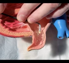 After years of implanting left atrial appendage occlusion (LAAO) devices in atrial fibrillation (AFib) patients, an interventional cardiologist with the University of Chicago Medical Center (UChicago Medicine) has developed a new device that could be a more affordable alternative to Boston Scientific’s Watchman and Abbott’s Amplatzer Amulet LAA Occluder. 