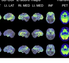 Combining PET and MRI data helps distinguish between LATE and Alzheimer's