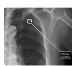 Qure.ai CAD chest X-ray reporting tool cleared by FDA