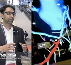 iad Ali, MD, DPhil, director of the DeMatteis Cardiovascular Institute and director investigational interventional cardiology, St. Francis Hospital and Heart Center, explains how coronary computed tomography angiography (CCTA) offers a shift in cardiac care and interventional cardiology because of the information it offers on plaque burden and ischemia based on fractional flow reserve CT (FFR-CT). #TCT #YesCCT
