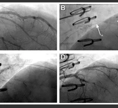 Angiography demonstrates a high-grade, modestly angulated stenosis (arrow) in the proximal segment of a large diagonal branch (A). Predilation performed with difficulty, and the GEC could not be advanced beyond stenosis even with “inch worming” techniques. (B). Advancement of the CrossFAST (C) beyond the proximal stent edge stenosis (a.), the position of the distal end of the outer catheter (b.), and the microcatheter tip (c.) are indicated.