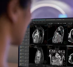 Philips has secured U.S. Food and Drug Administration (FDA) clearance for SmartHeart, the company’s new artificial intelligence (AI)-powered planning technology for cardiac MR (CMR) exams. 