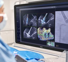 Philips has secured U.S. Food and Drug Administration (FDA) clearance for EchoNavigator R5.0 with DeviceGuide, the company’s artificial intelligence (AI)-enabled software for mitral transcatheter edge-to-edge repair (M-TEER).