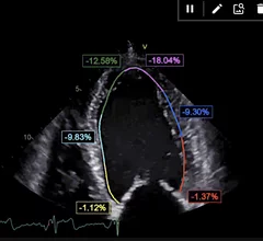 Ligence Heart is a recently FDA cleared AI that fully automates analyses, measurements and reporting for transthoracic echo.