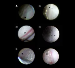 Selection of stent images captured with the MicroAngioscope from Vena Medical. Images courtesy of Kan et al. and Stroke.