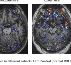 'Leaky' blood brain barrier causes long-term damage years after head injuries