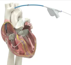 OmniaSecure defibrillation lead approved by FDA for placement in LBB area