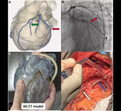 Vascudyne's off-the-shelf conduit for CABG surgeries