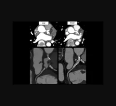 intrasaccular flow disruptor coronary aneurysm 