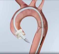 Emboliner® Embolic Protection System
