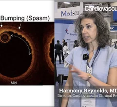 Harmony Reynolds, MD, FACC, director of the cardiovascular clinical research center at NYU Langone Health, presented a study at the American College of Cardiology (ACC) 2026 meeting using coronary optical coherence tomography (OCT) and cardiac magnetic resonance imaging (MRI) to determine sex differences in underlying causes of myocardial infarction with no obstructive coronary arteries (MINOCA).