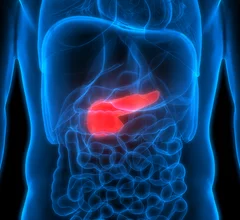 AI helps spot pancreatic cancer over a year before radiologists can