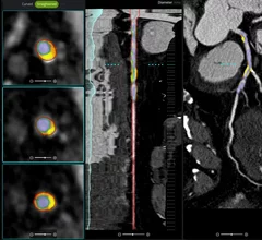 cvi42 | Plaque Circle Cardiovascular Imaging