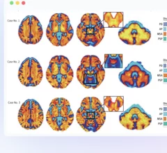 Neuropacs for Parkinsonian syndromes