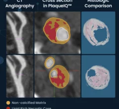 Elucid's new Lesion Analysis Tool now commercially available