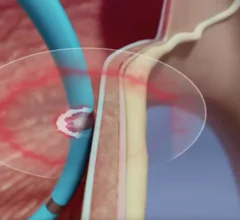 pulmonary hypertension denervation pulnovo medical
