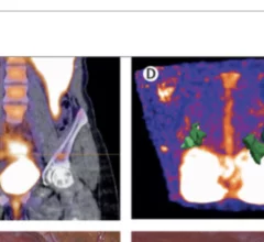 Endometriosis radiotracer performs well at clinical trial