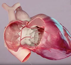 The U.S. Food and Drug Administration (FDA) has approved an investigational device exemption (IDE) to conduct a pivotal clinical trial for TRiCares Topaz transcatheter tricuspid valve replacement (TTVR) system in the U.S. The TTVR system uses two stent frames, one for the valve and one to engage the annulus with a membrane shirt between them to enable flexing of the outer ring to better seal against regurgitation.expansing stents 