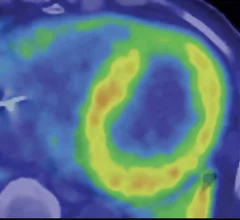Cardiac amyloidosis on nuclear imaging of the heart using 11C-PiB PET/CT. Image courtesy of RSNA