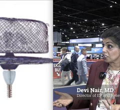 Devi Nair, MD, director of electrophysiology and research, St. Bernards Medical Center and Arrhythmia Research Group, explains how she uses concomitant left atrial appendage occlusion during EP procedures, and talks about new LAAO devices and ICE imaging.