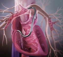 Jupiter Endovascular's Vertex Pulmonary Embolectomy System showed positive results in its SPIRARE II pivotal trial.