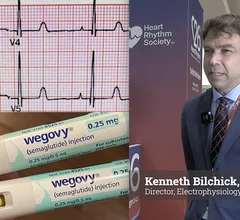 Kenneth Bilchick, MD, MS, Director of Electrophysiology Research, and a professor of cardiovascular medicine at the University of Virginia, explains GLP-1 receptor agonists (GLP-RAs) may do more than drive weight loss—showing a significantly lower risk of atrial fibrillation.