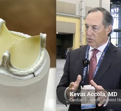Kevin Accola, MD, a cardiac surgeon at Advent Health in Orlando, Florida, explains the 10-year results from the COMMENCE aortic trial that shows long-term durability and sustained performance of its Resilia surgical aortic valve. The data were presented at the American Association for Thoracic Surgery (AATS) 2026 annual meeting this week. #AATS #AATS26 #AATS2026
