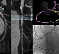 CCTA characterization of a chronic total occlusion with angiographic correlation during percutaneous coronary intervention.
