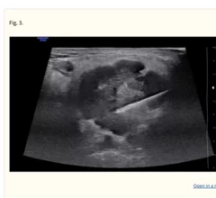New ultrasound needle yielded more substantial tissue samples