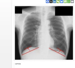 Diaphragmatic dome height could inform lung cancer surgery outcomes