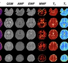 New MRI technique could improve diagnosis and treatment of MS