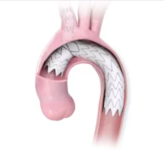 Nexus Aortic Arch System Artivion Endospan