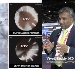 Video: Vivek Reddy, MD, Director, Cardiac Arrhythmia Service, The Leona M. and Harry B. Helmsley Charitable Trust Professor of Medicine in Cardiac Electrophysiology, Icahn School of Medicine at Mount Sinai, explains studies on the latest pulsed field ablation and leadless conduction pacing trials. #PFA #conductionpacing