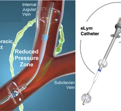 The WhiteSwell eLym catheter-based device for lymphatic drainage in acute decompensated heart failure (ADHF) patients.