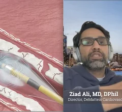 Ziad Ali, MD, DPhil, director of the DeMatteis Cardiovascular Institute, St. Francis Hospital and Heart Center, spoke with Cardiovascular Business about his center's experience using the recently released Johnson & Johnson MedTech next-generation Shockwave C2 Aero Coronary IVL Catheter to treat calcified coronary artery disease. Ali said his center was the first in the world to use the catheter in August 2025 and has since gained experience in roughly 80 cases.