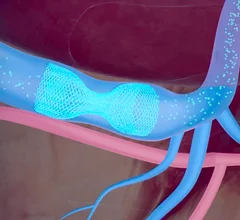 The A-FLUX Reducer System from VahatiCor is designed to treat coronary microvascular dysfunction.